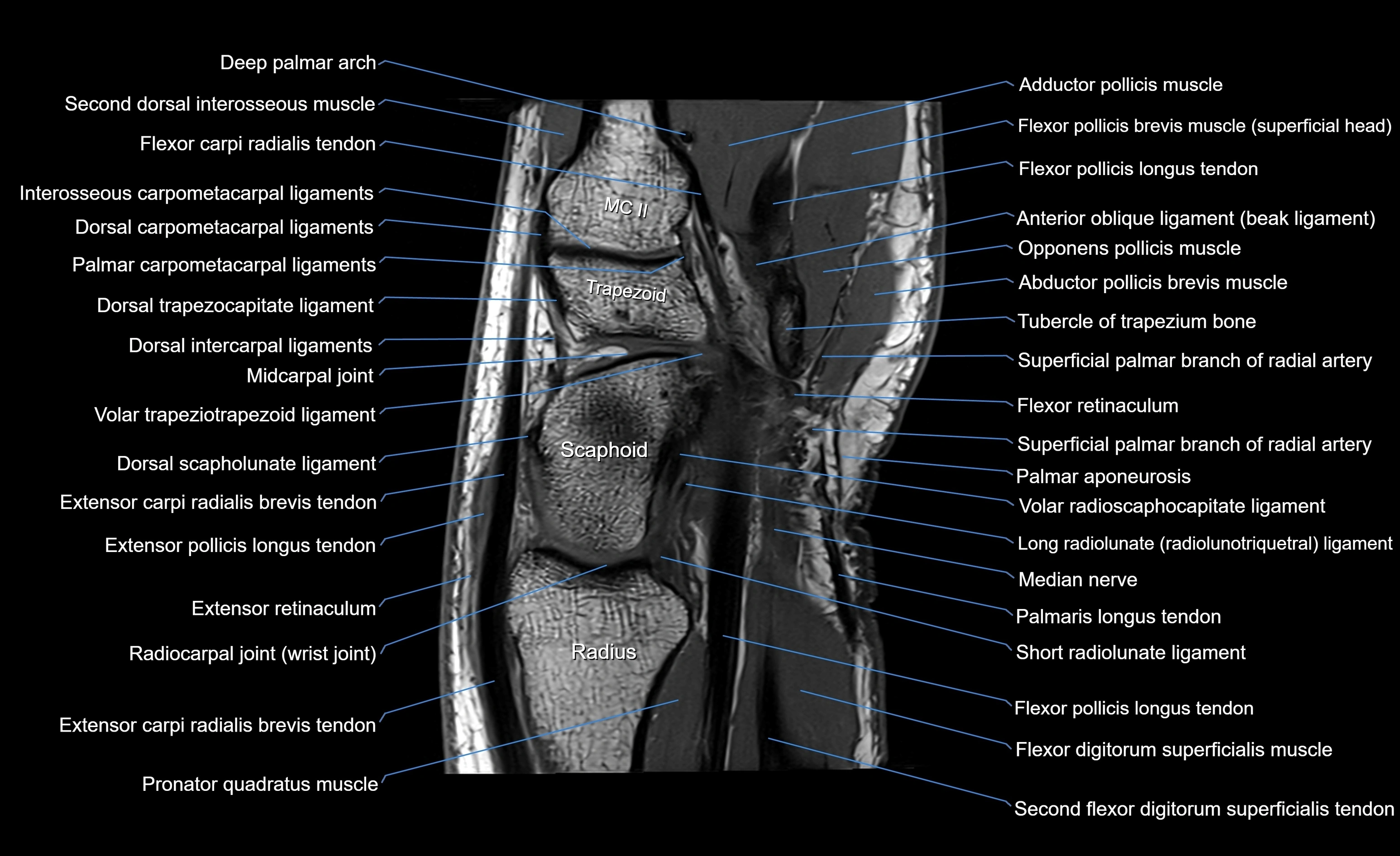 MRI wrist sagittal cross sectional anatomy 3T  radiology  image-img-00001-00009.webp